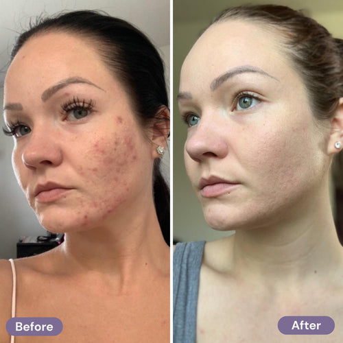 Jenvra High-Frequency Wand (Acne)